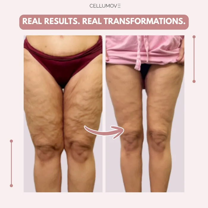 Lazzda 3D Legging – Say goodbye to lipoedema pain and swelling naturally - Image 3