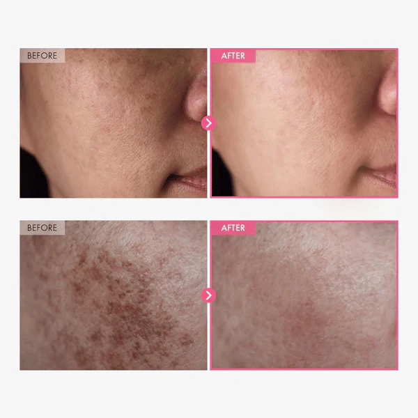 Arbutin 7% + Tranexamic Acid 4% Cream - Image 5