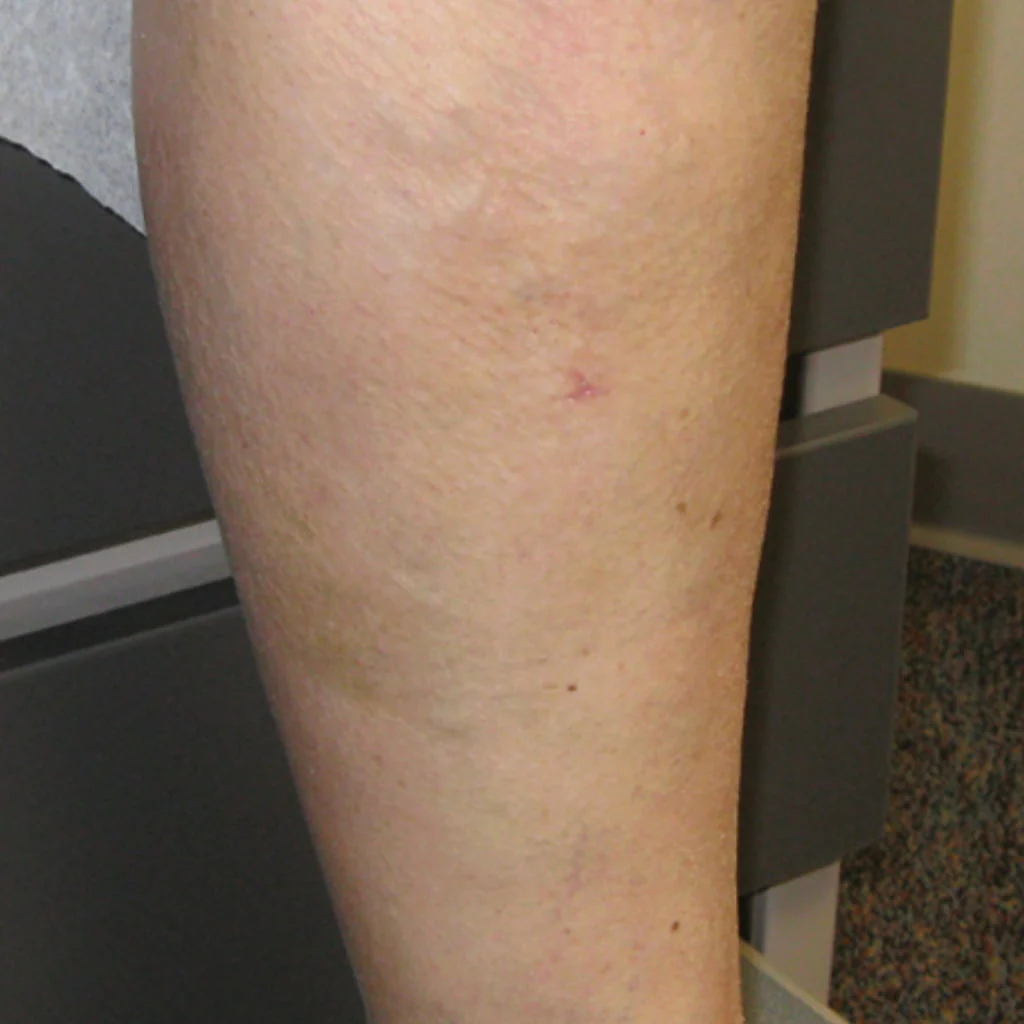 C-Varicose Vein Cream - Image 3