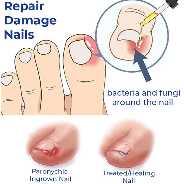 Lazzda Removal Paronychia - Image 7